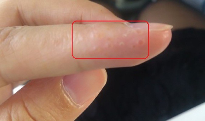 7 dấu hiệu cảnh báo bệnh nguy hiểm biểu hiện trên bàn tay của bạn
