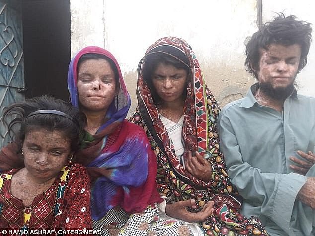4 đứa con bị hàng xóm hắt hủi vì mắc bệnh lạ, người cha khốn khổ phải cầu xin sự giúp đỡ của mọi người