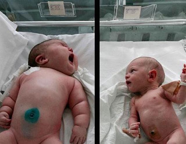 Choáng váng với bé sơ sinh 18kg, nặng nhất trong lịch sử các ca sinh thế giới