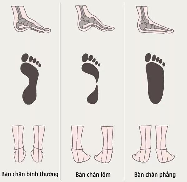 Đi giày cao gót, người phụ nữ mắc bệnh “bàn chân bẹt“: kiểm tra ngay trước khi quá muộn!