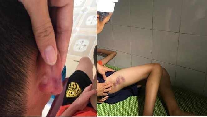 Vụ bé trai 12 tuổi nghi bị mẹ kế bạo hành đến nhập viện ở Nghệ An: Mẹ kế trần tình vụ việc, thừa nhận sai