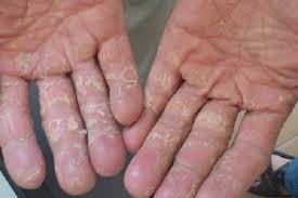 Bong da tay có phải do thiếu vi chất?
