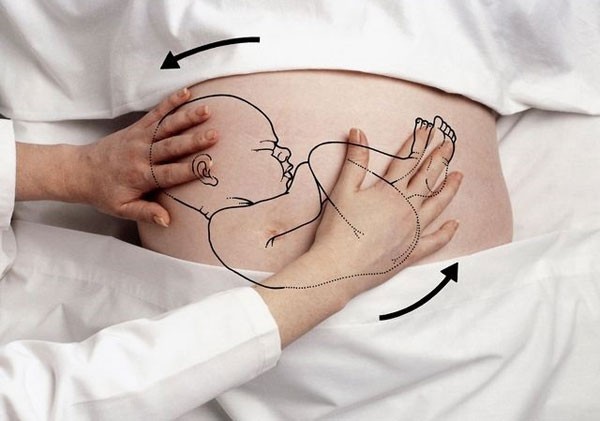 Những điều mẹ bầu cần biết khi được chẩn đoán có ngôi thai ngược