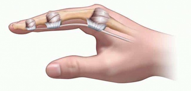 Cách chính xác nhất phân biệt bong gân cổ tay và gãy xương cổ tay để xác định cần phải nhập viện hay không