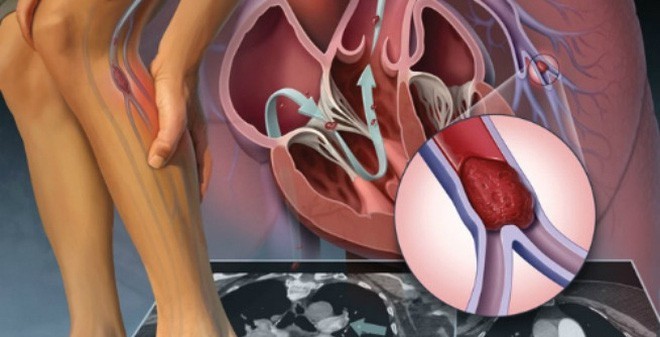 Đừng đùa với những đường gân “loằng ngoằng”, không cẩn thận có thể biến chứng vào tim, phổi