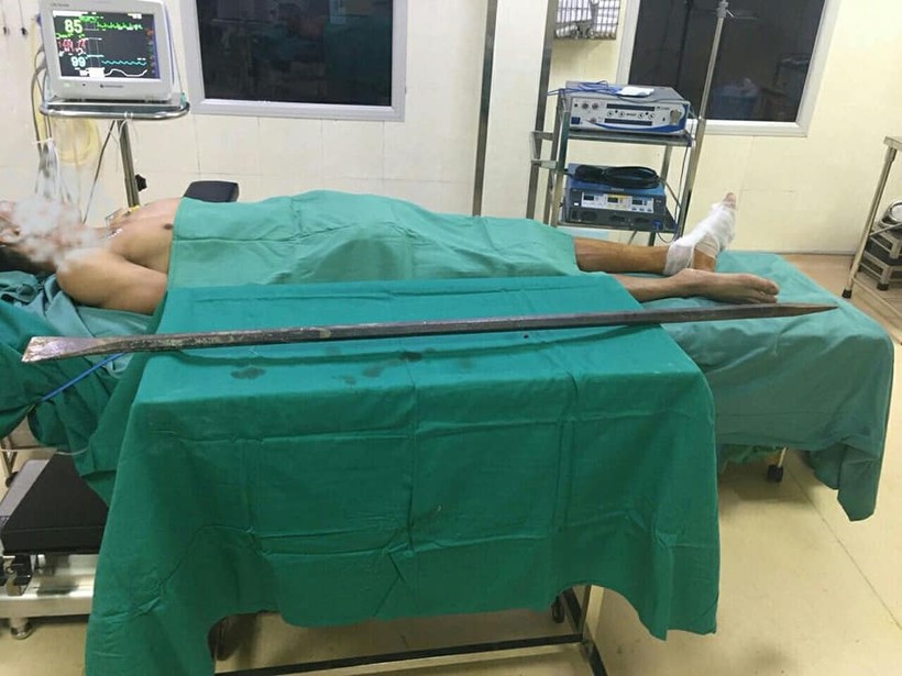 Chiếc xà beng đâm thấu chân bệnh nhân được bác sĩ phẫu thuật lấy ra