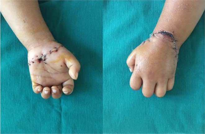 Bàn tay đứt rời của bé gái sau khi được các bác sĩ tái phục hồi, nối liền. 
