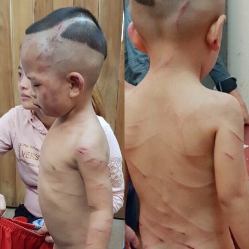 Kiên Giang: Khởi tố cha dượng đánh đập dã man bé trai 3 tuổi thương tích khắp cơ thể