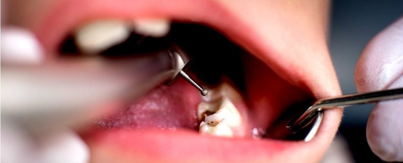 Nghiên cứu mới này sẽ khiến bạn không bao giờ dám quên đánh răng nữa