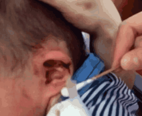 Con 3 tuổi liên tục gãi tai, mẹ tá hỏa khi bác sĩ kết luận cây mọc trong tai