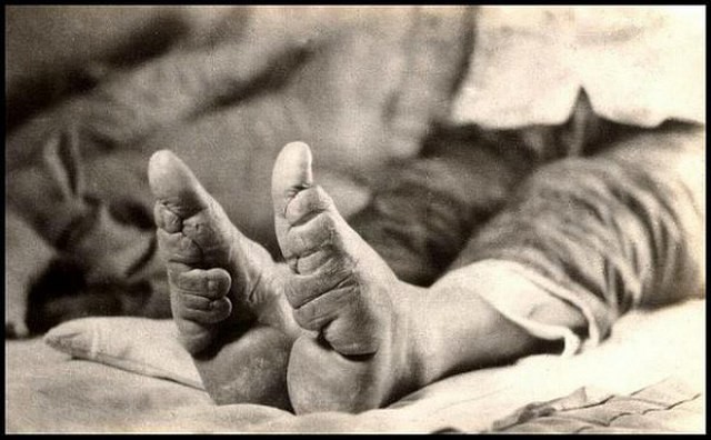Tục “Bó chân gót sen” của Trung Quốc xưa: Hình ảnh những đôi chân rỉ máu và biến dạng khiến phụ nữ thời nay phải nín thở nổi da gà