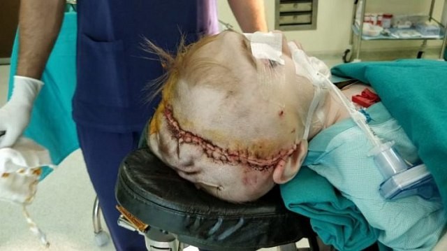 Phẫu thuật cô bé 2 tuổi có đầu to như quả bóng