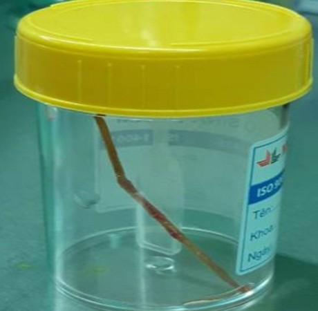 Chiếc tăm dị vật được lấy ra từ ổ bụng bệnh nhân