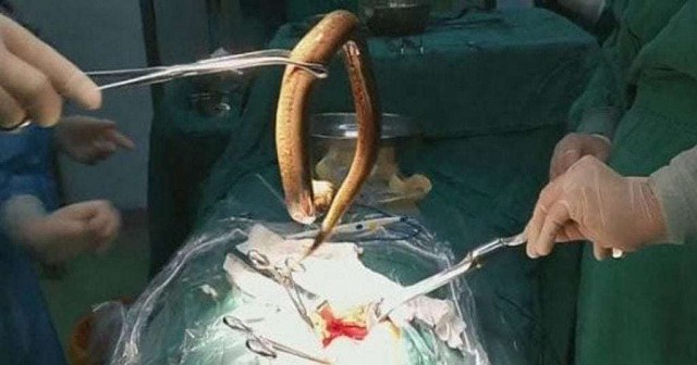 Người đàn ông lĩnh hậu quả vì nuốt lươn sống dài 30cm vào bụng