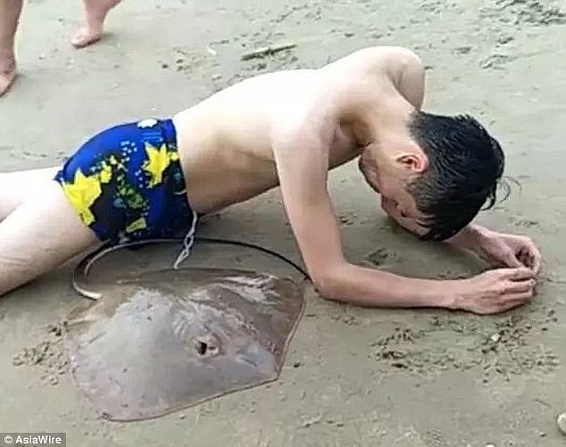 Bị cá đuối gai độc cắm vào người khi đi tắm biển