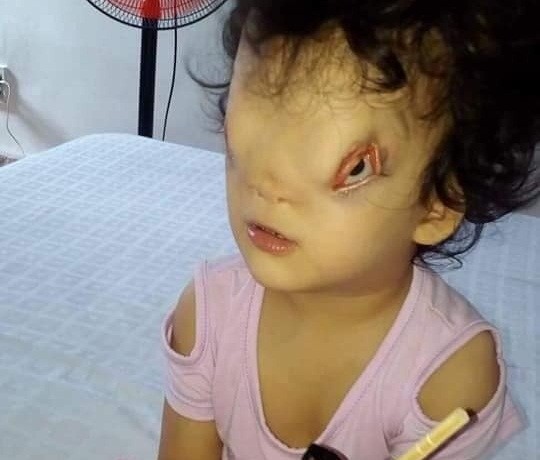 Xót xa số phận của bé gái 4 tuổi mang khuôn mặt dị dạng