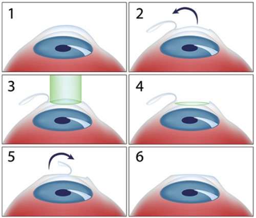 5 phương pháp chữa cận thị cho người không muốn đeo kính