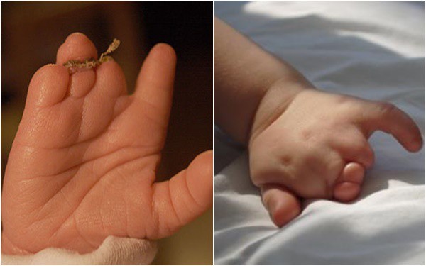 Mẹ lặng người khi sinh con ra không có bàn tay, bác sĩ mổ tìm thấy 1 bàn tay bé xíu còn nằm trong tử cung