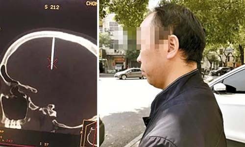 Phát hiện đinh dài gần 5 cm trong hộp sọ người đàn ông Trung Quốc