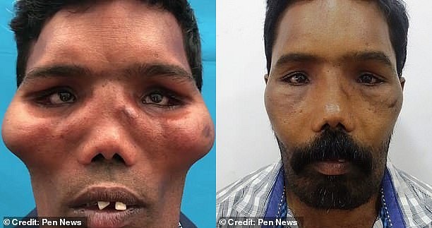 Người đàn ông mang ‘khuôn mặt sư tử’ suốt 23 năm vì bệnh siêu hiếm, thế giới mới có vài trường hợp
