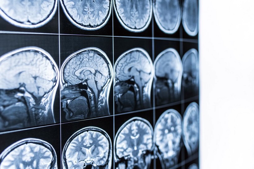 Ảnh chụp CT về não của những người mắc bệnh mà các nhà khoa học chưa lý giải được