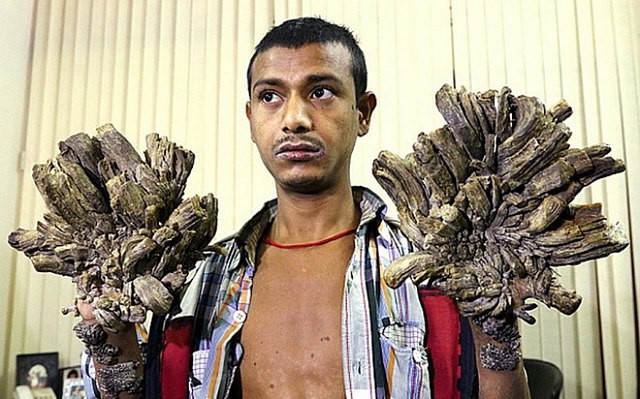 “Người cây” Bangladesh bước đầu phẫu thuật cắt bỏ 5kg “vỏ”