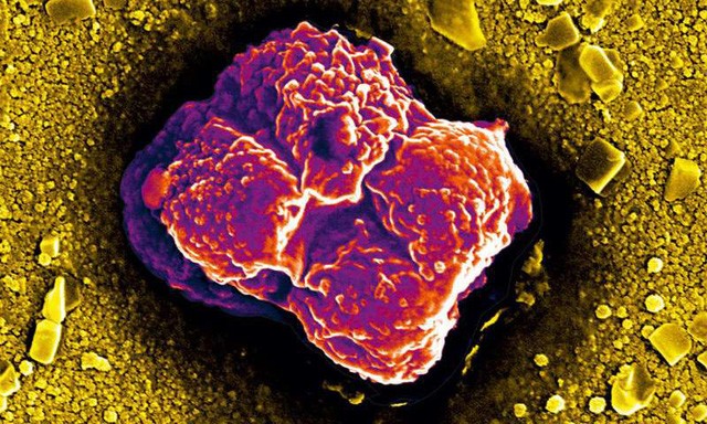 Tại sao tế bào ung thư lan rất nhanh khắp cơ thể?