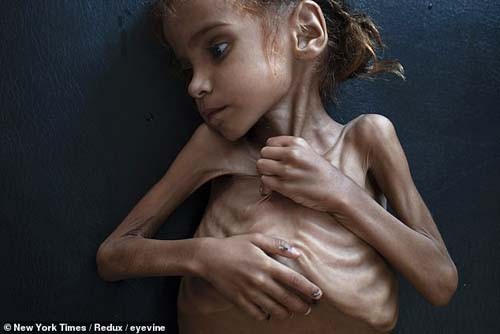 Bé gái gầy trơ khung xương gây chấn động về nạn đói ở Yemen