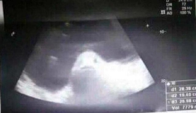 Sự thật đáng sợ đằng sau bức ảnh siêu âm “người mang thai cá"