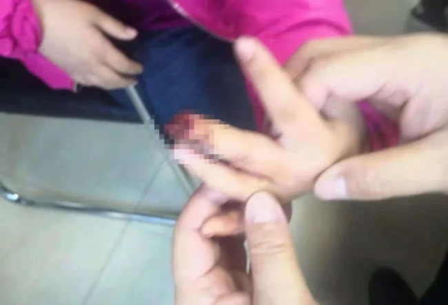 Bị kẹt tay vào cửa, bé gái 9 tuổi phải cưa ngón tay bà nội sơ cứu sai lầm