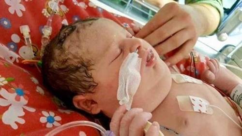 20 bác sĩ vây kín phòng mổ đẻ, lặng người nhìn em bé vừa chào đời 