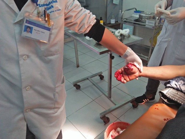 Anh Nguyễn Văn Khương nhập viện trong tình trạng bàn tay phải bị dập, ngón tay cái bị đứt lìa


