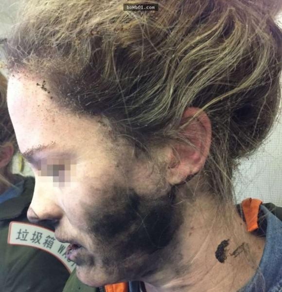 Cô gái bị cháy tóc, bỏng mặt vì sự cố tai nghe khi đi máy bay
