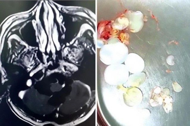 Bệnh nhân kêu buồn nôn, bác sĩ tìm thấy hơn 30 nang trứng sán trong đầu