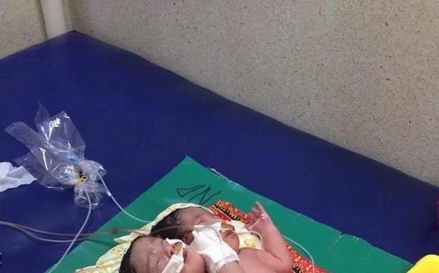 Em bé hai đầu, nặng 6,8 kg ra đời ở Campuchia