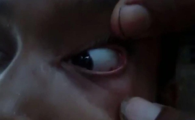 Bác sĩ sốc sau khi tìm thấy cả ổ kiến trong mắt bé gái