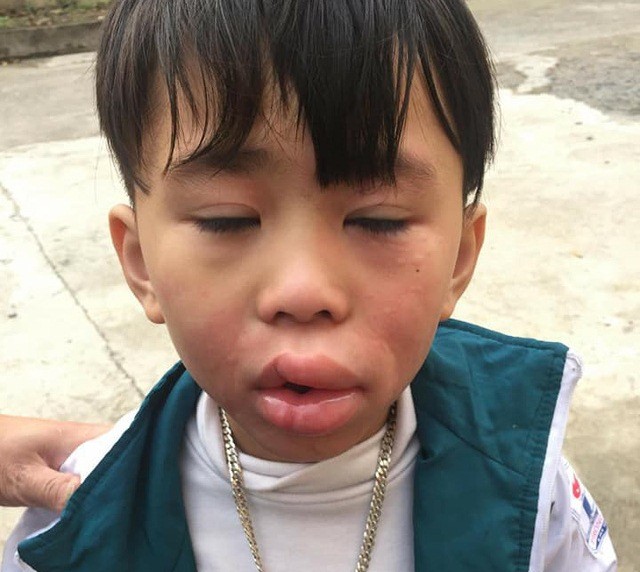 Một bé trai nghi bị ngộ độc sau khi ăn kẹo ở cổng trường