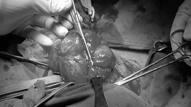 Khối bướu cổ của người bệnh được phẫu thuật cắt bỏ
