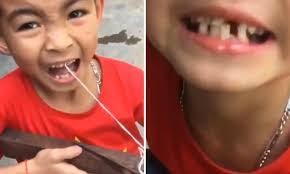 Clip cậu bé Việt Nam nhổ răng bằng nỏ lên báo Anh
