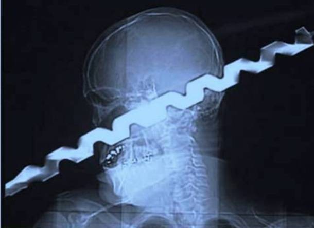 Những tấm phim chụp X-quang kinh dị nhất mà bạn từng thấy: bị mũi khoan, dao sắc xuyên thủng hộp sọ vẫn sống sót