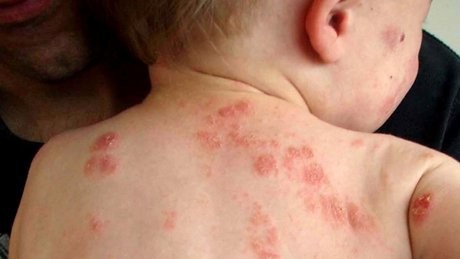 Cảnh giác với loạt bệnh về da thường gặp trong mùa hè