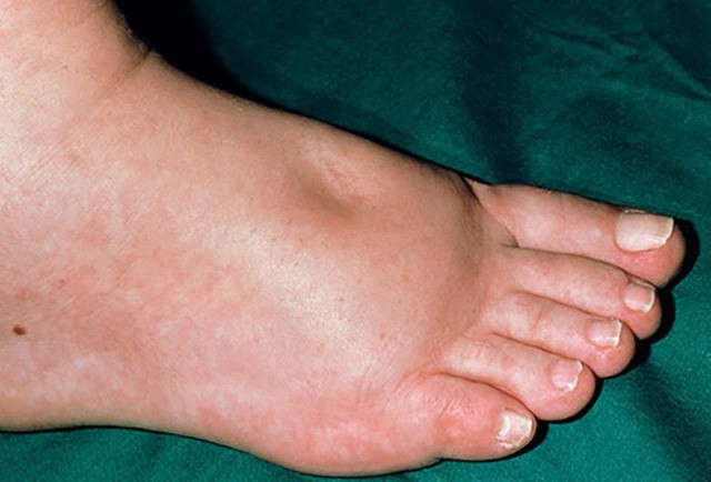 Bàn chân xuất hiện cùng lúc 3 dấu hiệu này, có thể thận đang có bệnh