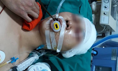 Hà Nội: Nửa đêm, nam sinh 17 tuổi bị đánh chấn thương sọ não