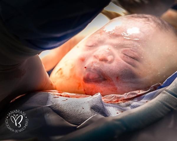 Em bé bĩu môi khi chào đời nằm nguyên trong bọc ối