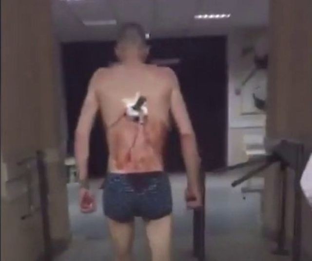 Kinh hoàng bệnh nhân dao cắm lút cán trên lưng đi bộ ra ngoài bệnh viện 