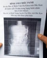 Phim chụp chiếc panh trong bụng bệnh nhân (ảnh nguồn Internet)