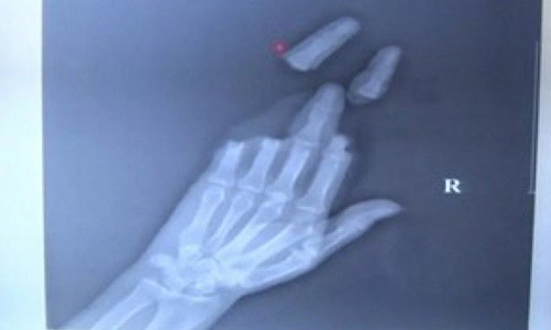 Ảnh chụp X-quang cho thấy ba ngón tay của một người đàn ông ở Giang Tô bị đứt rời sau khi thả diều trong gió lớn. Ảnh: SCMP.