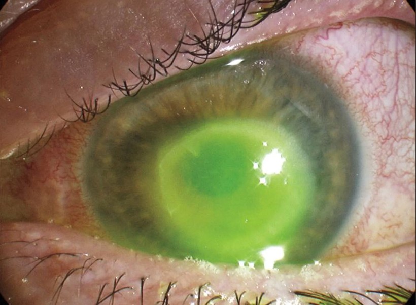 Tổn thương ở mắt của nạn nhân đeo kính áp tròng khi bơi tại Anh.