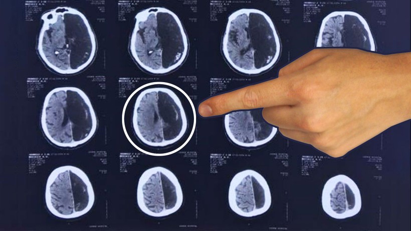 Hình ảnh chụp não của bệnh nhân.