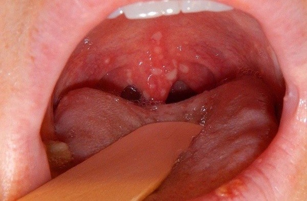 Ung thư vòm họng có liên quan đến virus EBV. .